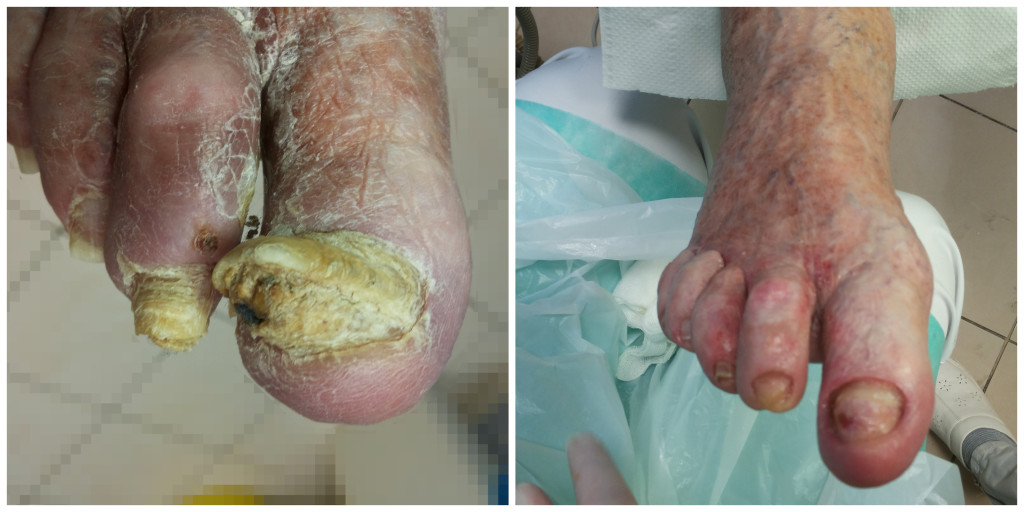 Zaawansowana grzybica paznokci. Zdjecie przed i po zabiegu podologicznym.