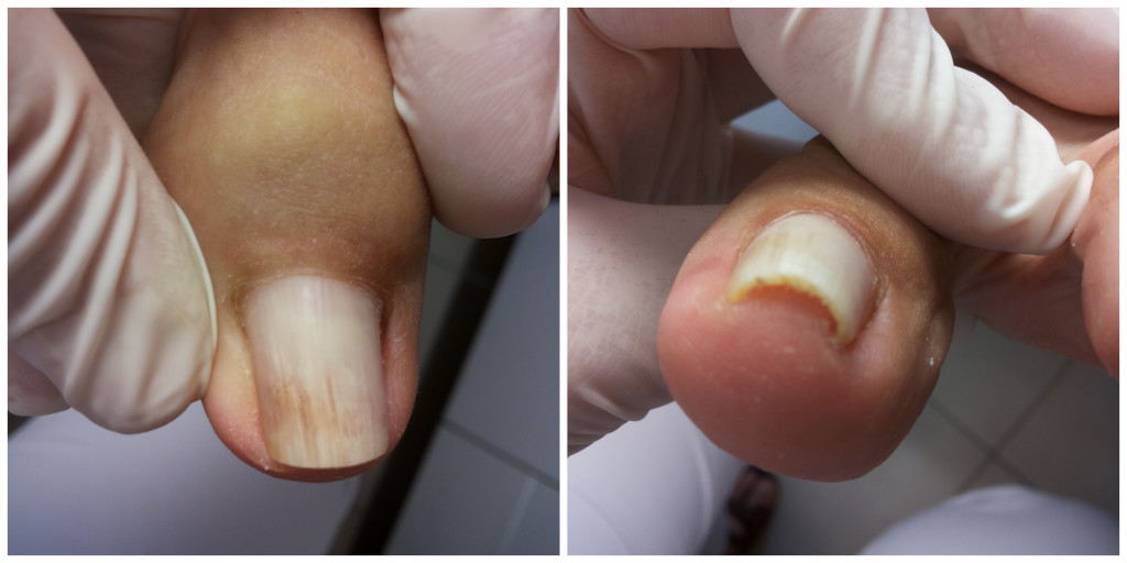 Wkręcający się paznokieć podczas zaburzeń hormonalnych.